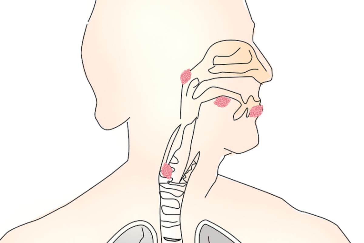 Cancro alla gola